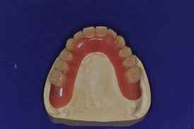 Sind im mund nur noch sehr wenige zähne z.b. Patient Aus Der Region Eckernforde Erhalt Neue Implantatgestutzte Cover Denture Prothesen Cmd Patientenratgeber