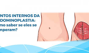 Pontos Internos Da Abdominoplastia Blog Master Health