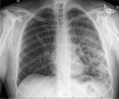 Image result for Pneumothorax