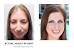 Hair Transplant Graft Cost