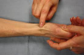 A tfcc tear is an injury to the triangular fibrocartilage complex found in the wrist. Tfcc Tear Lockeroom Health