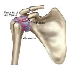 Intercostobrachial Neuralgia Armpit Nerve Pain Dr Jason Attaman Seattle Pain Management Doctor