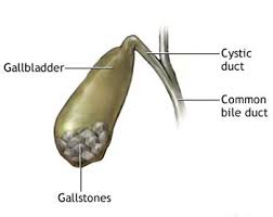 Image result for Gallstone