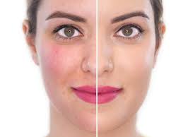 Here, a dermatologist and a plastic surgeon explain the procedure and the possible benefits on skin. Learn More About Rosacea With Cynthia Eaton Aprn Cnp Twin Ports Dermatology Duluth Mn