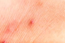 Image result for flea bites