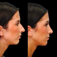 Looking beautiful and breathing easier🌟 Dr. Joseph performed a septoplasty  and rhinoplasty