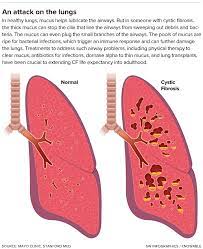 Cf pri­ marily affects the respiratory and digestive systems in children and. Moving Forward With Cystic Fibrosis