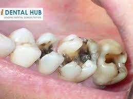 How To Get Pink Gums Causes Of Dark Gums Treatment Of Dark Gums Dark Gums Around Tooth Dental Fillings Dental Cavities Dental