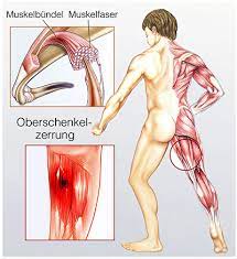 Muskelzerrung Ursachen Symptome Behandlung Medlexi De