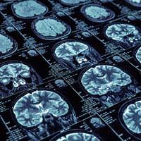 Dementia pugilistica(dp) is a type of chronic traumatic encephalopathy(cte), a neurodegenerativedisease with features of dementia. What Is Dementia Pugilistica Court Theatre