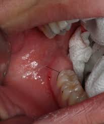 Image result for Alveolitis sicca)