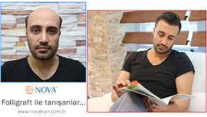 Nova Hair Adli Kullanicinin Folligraft Protez Sac Panosundaki Pin Genetik Sac Dokulmesi Sac