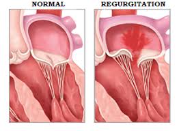 Mitral Regurgitation Explained Myheart Net Mitral Valve Mitral Valve Prolapse Mitral Valve Regurgitation