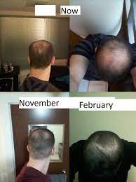 It is best never to start with this drug. Hair Loss After Stopping Minoxidil And Then Restarting Pics Hairlosstalk Forums