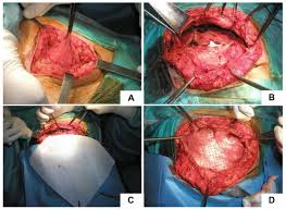 We did not find results for: Incisional Hernias Post Liver Transplantation Current Evidence Of Epidemiology Risk Factors And Laparoscopic Versus Open Repair A Review Of The Literature In Vivo