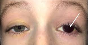 Image result for Hyphema