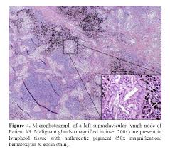 Enlarged lymph nodes above the collarbone (supraclavicular lymphadenopathy) are always considered abnormal. Isolated Supraclavicular Lymph Node Metastasis In Pancreatic Adenocarcinoma A Report Of Three Cases And Review Of The Literature Insight Medical Publishing