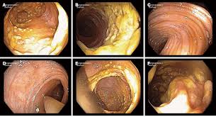 Image result for Fecal Transfer