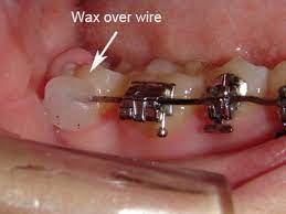 How to use orthodontic wax for braces. Treatment Support