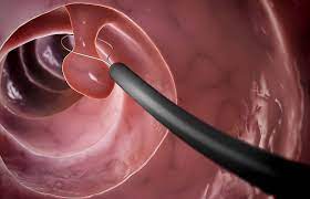 Der stuhl ist entweder verfärbt oder zeigt blutauflagerungen. Polypen Was Sind Polypen Wie Entstehen Sie Minimed At