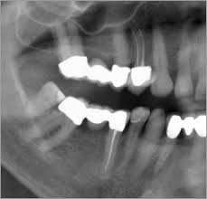 Wann eine wurzelbehandlung stattfindet, entscheiden zahnärzte anhand folgender kriterien gelingt dies nicht, ist eine operation nötig. Wurzelbehandlung Zahnarzt Fur Endodontie In Koblenz