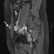 The aim of this study was to describe the appearance of awe on magnetic resonance (mr). Abdominal Wall Endometriosis Eurorad