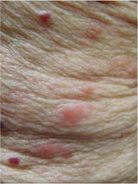 Image result for scabies in the groin area