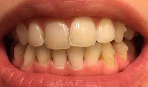 When you get yellow or brown stained teeth from smoking, the discolouration can be quite noticeable and hard to get rid of. How Can I Get Rid Of The Brown Stains Between My Teeth Photos