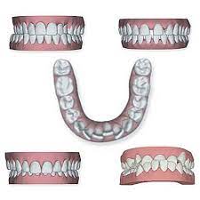 Folglich ist bei einer modernen therapie der aufwand an zeit in den meisten fällen stark erhöht. Zahnspangen Kosten Zuschusse Der Kassen Ratenzahlung Steuerliche Absetzbarkeit