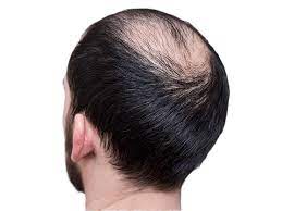 È risaputo che la perdita di capelli può essere dovuta sia a fattori come stress, alimentazione o stile di vita insano, sia a predisposizione genetici ed . Perche Cadono I Capelli Ecco Le Cause Principali