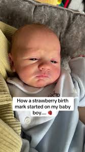 STRAWBERRY BIRTH MARK AWARENESS! 🍓 #strawberry #strawberrybirthmark  #birthmark #birthmarkawareness #birthmarkbaby #babytips