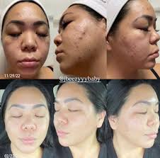 Does panoxyl help with acne and oil control?