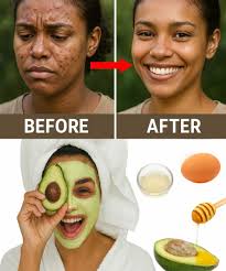 Say Goodbye to Blackheads with Just One Egg