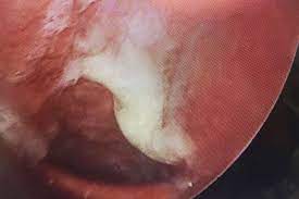 Retronasaler Schleimfluss Postnasal Drip Syndrom Pnds Hno Praxis