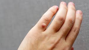 A tumor sounds scary, but it is basically any abnormal lump or bump. What Is A Skin Lump Symptoms Causes Diagnosis Treatment And Prevention Everyday Health