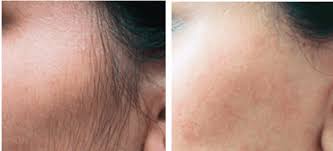 Laser hair removal does all that and more. Laser Hair Removal My Spa Rituals