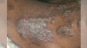Image result for itchy skin rectum
