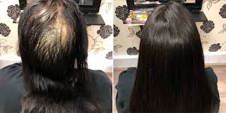 It's quite a common myth that when you shave your hair that it will grow. Hair Loss Mesh Integration Systems The Best Solution For Hair Loss