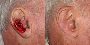 There are a number of different treatments doctors recommend. Ear Reconstruction Skin Cancer And Reconstructive Surgery Center