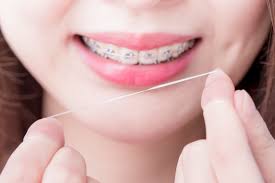 Teeth with braces need to use the best quality toothbrush like soft bristle or electric brush that can rotate to cover the most of the area and clean your teeth. How To Clean Teeth With Orthodontic Appliance