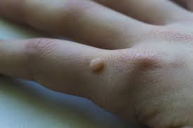 The cause for warts is an infection with the human papilloma virus (hpv). Warts Causes Risk Factors Symptoms And Treatment Options Florida Dermatology Skin Cancer Centers