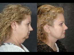 Lower Facelift and Necklift Before and After