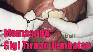 We did not find results for: Memasang Kembali Gigi Tiruan Mahkota Jembatan Youtube
