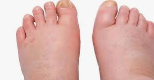 5 remèdes de grand mère pour soigner une contusion. 4 Solutions Anti Pieds Gonfles
