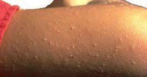 Si En Tus Brazos O Piernas Tienes Esos Pequenos Granitos Asperos Que Le Dan A Tu Piel Aspecto De Piel De Ga Granitos En Las Piernas Queratosis Pilar Queratosis