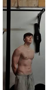 Image result for Pectus Excavatum