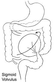 Image result for Sigmoid Volvulus