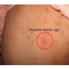 Image result for Urticaria pigmentosa children