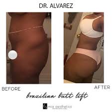 Alvarez, founder of mia aesthetics specializes in plastic surgery that fits each patient's goals. Mia Aesthetics Bbl By Dr Alvarez Bbl Dralvarez Alvarezdoll Miaaesthetics Facebook