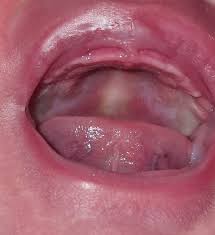 Image result for Oral thrush roof of mouth